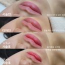카멜뷰티 | 입술문신 잔흔커버 + 윗입술 확장 인중축소반영구 한달뒤 (홍대 신촌 이대)