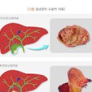 담낭암 증상 예방 치료 정보 이미지