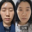 함께웃는한의원 | [아름턱 한의원] 아름턱한의원 52회 치료후기 (스컬트라 3회 + 관자 엘란쎄 + 경락 + 다이어트)