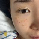 지성약국 | [ 비립종/편평사마귀제거] |Co2 레이저 제거 성지 후기 / 경과