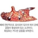 폐결핵 이미지