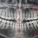 사랑니 뺀 자리에 임플란트 이미지