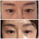 하루에 멍 | 안검하수 쌍꺼풀 재수술 눈매교정 후기 ,통증,멍,붓기