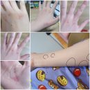 이재철피부과의원 | 만성두드러기 극복후기2/두드러기, 알레르기, 장누수 관련 도서 공부하기