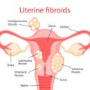 자궁근종 원인 증상 크기 낫는법 예방 이미지