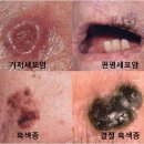 상피내 신생물[IN SITU NEOPLASMS] 피부질환 이미지