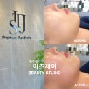 청주 소노온리프팅 율량동 피부관리 / 이츠제이 청주점