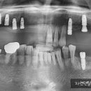병천치과의원 | 천안치과/목천치과/병천치과 - 전체 임플란트 치료가 마무리되었습니다^^