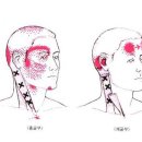 턱관절-두개골-경추 위치이상으로 인한 두통 이미지