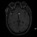 LCCA and subclavian a. stenosis 이미지