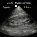 Renal Ultrasound - Hydronephrosis - SonoSite, Inc. 이미지