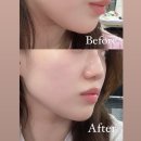 프로메디 | 프롬메디 알파 샷 이펙터 / 홈케어 뷰티 디바이스로 울쎄라 효과 리얼 후기✨