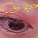 삼성연합의원 | [안동 안과 - 안동삼성연합안과의원] 콩다래끼를 부탁해요!! (+ 추가 후기)