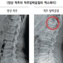 골다공증 및 정보방법 살펴보세요 이미지