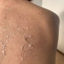 약초한의원 | 노원역 여드름 한의원에서 등 약초필링한 후기