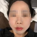세라핏 | 압구정로데오 압구정피부과 갸름한 브이핏 압구정 울쎄라 프라임 200샷+V핏주사 후기
