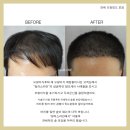 일러스라인 | 신림 일러스라인 smp로 자신감 up 탈모치료 후기!