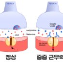 쌍꺼풀을 시작으로 전신 근육이 풀렸다! ‘중증 근무력증’ 의심 증상 &amp; 치료 이미지