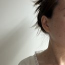 쾌의원 | 이삭가정의학과의원 편평사마귀 제거 | 1~7일차 상세후기