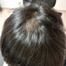 서울비뇨기과의원 | [서울탑비뇨기과의원] 두피원형탈모 치료 리얼후기