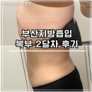 부산지방흡입 복부 2달차 후기(feat. 후관리, 다이어트,통증,붓기)