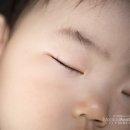 선천성 모반, 후천성 오타모반 치료 (오타반점, 아기) 이미지