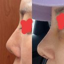 코 전체제거 이주차 후기(코 구축,염증)