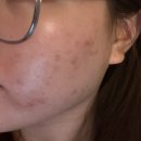 폼의원 | [여드름 관리] 모즈의원 청담 피부 관리 4회차...공유 | 메이크프렘 클랜징폼 추천 | 토리든 마스크팩 후기