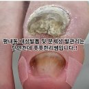 평내약국 | 평내동 내성발톱 및 문제성 발관리는 단언컨데 풋풋한리쌤입니다.!