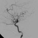 뇌혈관 뇌동맥류 및 원인검사 이미지