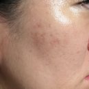 지장한의원 | 상계동피부과 새살침 한의원 패인흉터 치료 후기 - 6회차