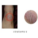 만성 단순 태선(Lichen simplex chronicus) 피부 질환이란? 이미지