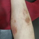 서라벌한의원 | 부산아토피한의원? 스테로이드 먹어도 계속 뒤집어지는 분게 드리는 편지