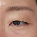중앙로1275번길 | 아이리쥬란 시술 3회 눈밑주름 눈가탄력 내돈내산 효과 통증 부작용 후기
