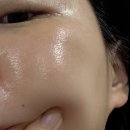 크림의원 | 사마귀 제거 성지(?) 병원 예약, 내돈내산 시술 후기 2달 지난 후기!(연세 ㅂㄷㅁ의원), 재생크림 추천!