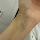 모야모야 | 모야모야병 수술 후기