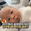 원보조기 | 두개골 조기유합증과 사두증 차이, 아기 머리가 길 때 확인할 점