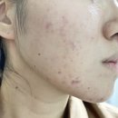 카프리 | 카프리레이저 후기 가격 주기 관리 방법