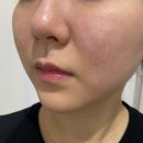 튠스타트 | 서현역 피부과 리프팅 튠페이스 중안부 심부볼 팔자주름 내돈내산 후기