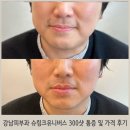 강남피부과 슈링크유니버스 300샷 통증 및 가격 후기