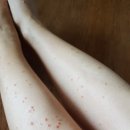 대학병원 예약해두었는데.. 광선치료 먼저 시작할까요? 이미지