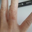 지메디 | [공지] 달구어진 팬에 데인 손가락 접촉화상, 실버스트림 용액사용 전과 후