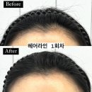 구미 문성 밀라뷰티 헤어라인 SMP 받고 자연스럽게 이뻐졌어요