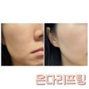 불독 - 김포시 | 부산 온다 리프팅 이벤트 가격 후기 불독살 고민으로 받아본 리프팅 후기