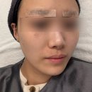 강남역 피부과 기미 잡티 섹소레이저 피코토닝 후기