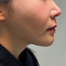 2차는 | 신논현피부과 내돈내산 옆볼패임 쥬베룩볼륨 2차 후기