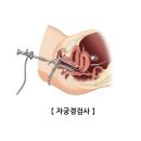 ep.07 자궁경 용종 제거술 난임 임신 준비 싸이토텍정 후기 아인병원