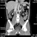 R/O Lipoma 이미지