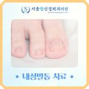 서울파고드는발톱 방치하면 내성발톱으로 고생합니다