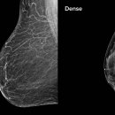 유방암 최대 위험요인, 치밀유방(Dense breasts) 이미지